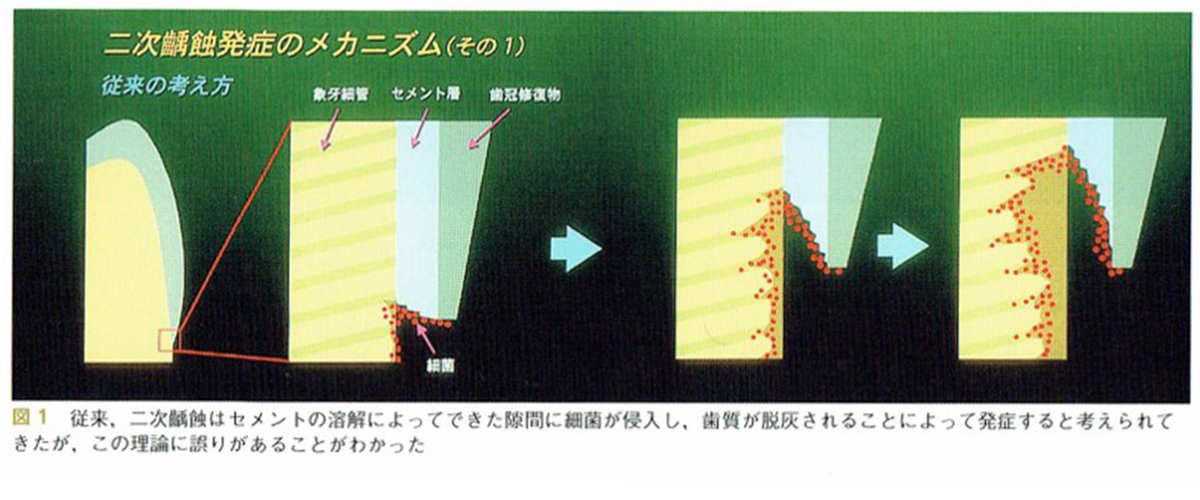 予防的補綴修復