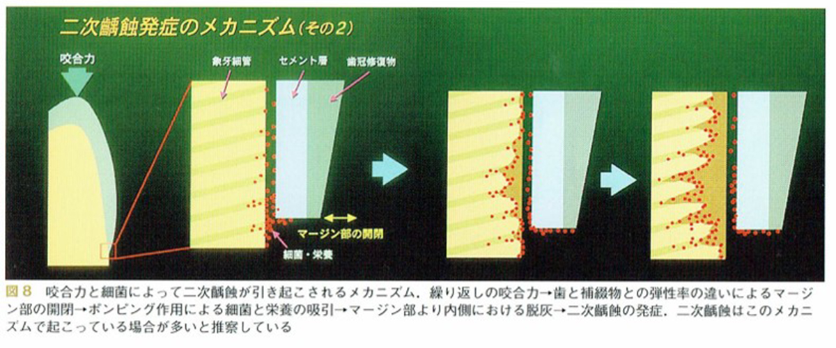予防的補綴修復