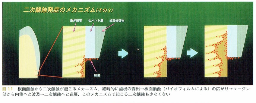 予防的補綴修復