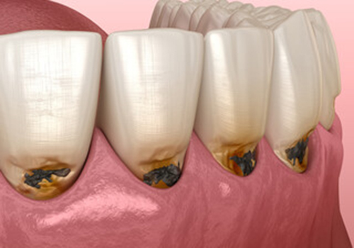 予防的補綴修復