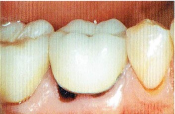 予防的補綴修復